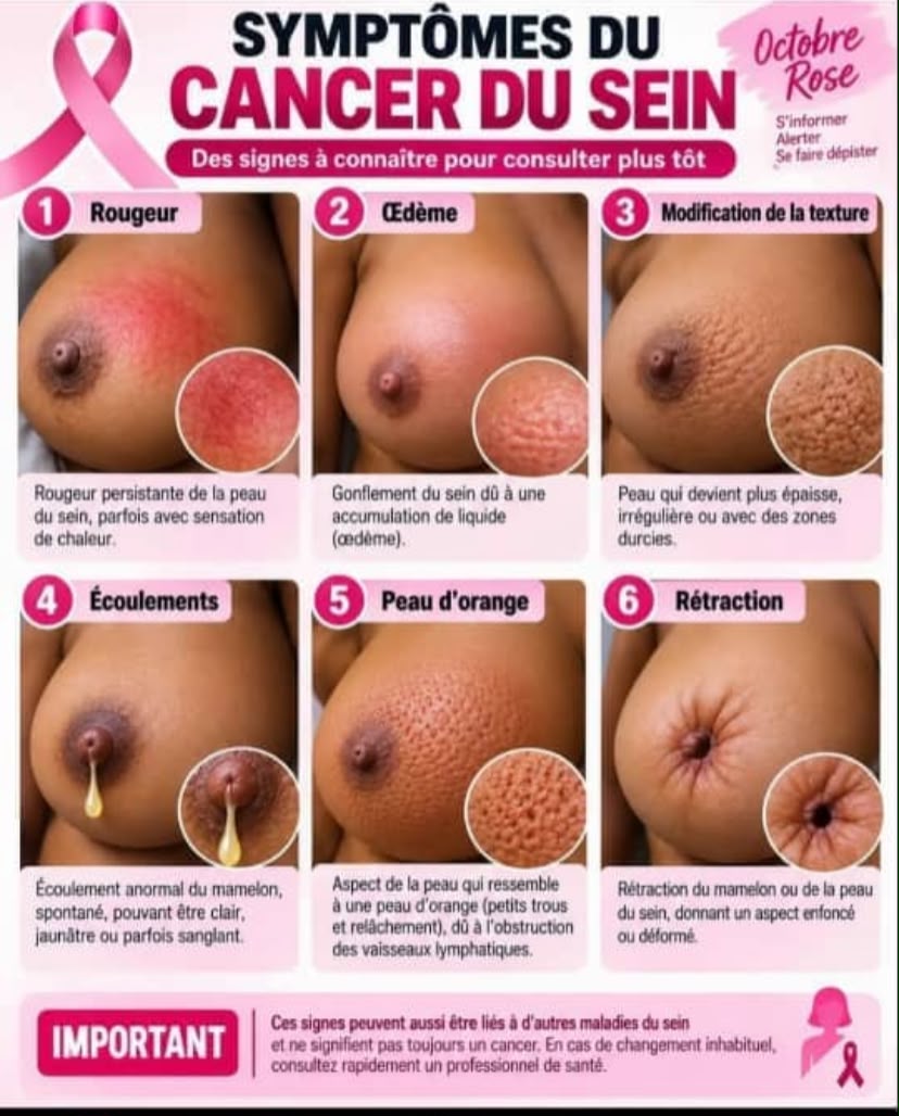 Octobre Rose : ces signes du cancer du sein qu’il ne faut pas négliger